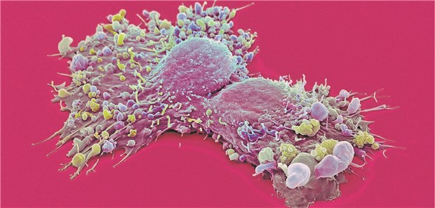 Brustkrebszellen. Haben sie Metastasen gebildet, wird die Therapie meist sehr schwer.