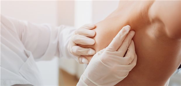 Brustuntersuchung: Intervallkarzinome verlaufen öfter tödlich als im Screening entdeckte Karzinome.