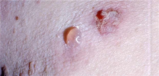 Bullöses Pemphigoid: Eine solche Erkrankung wurde unter Therapie mit DPP-4-Hemmern häufiger beobachtet als bei Therapie mit Sulfonylharnstoffen der zweiten Generation.