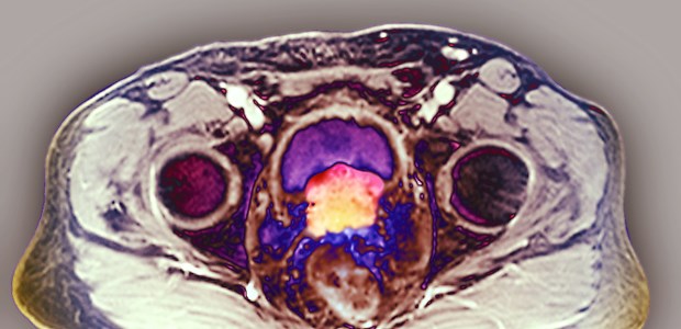 Glutamat als Tumormotor? Bunt und ungesund.