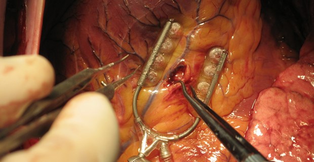 Bypass schlägt Stent Bypass-Op: Für Diabetiker mit fortgeschrittener KHK die bessere Option.