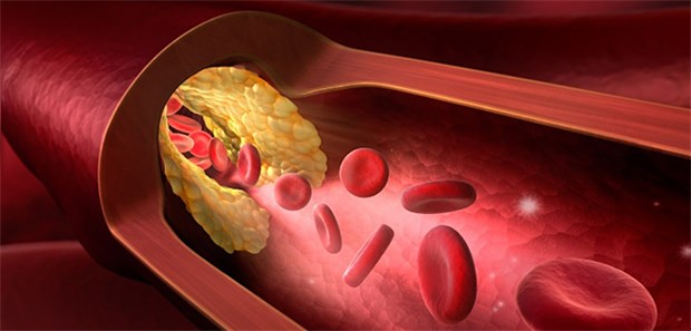 Bypass oder perkutane Koronarintervention? Das ist oft die Frage bei Patienten mit Koronarsklerose.