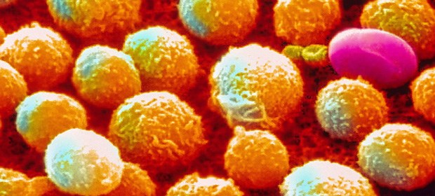 Keine Handhabe gegen eine Marktrücknahme CLL: Alemtuzumab nur noch über Clinigen.