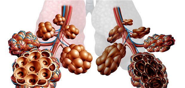 COPD: Erkrankungen außerhalb der Lunge haben einen wesentlichen Einfluss auf die Morbidität und Mortalität von COPD-Patienten. EIne weitere Erkenntnis aus dem COSYCONET-Projekt: Es konnten eine Reihe von Risikokonstellationen ermittelt werden, die mit einer erhöhten Mortalität einhergehen.