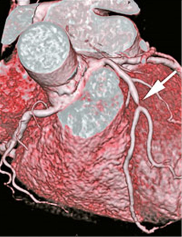 'Anatomische' Diagnostik überzeugt nicht ganz CT-Angiografie der Koronarien mit massiver Stenose.