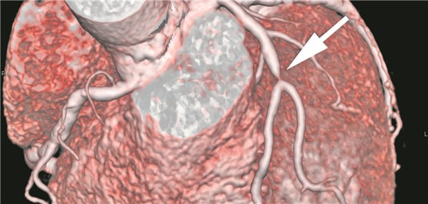 CT-Angiographie des Herzens mit Nachweis einer ausgeprägten Koronarstenose.