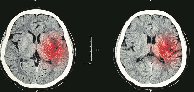 Plättchenhemmung hat kaum Nachteile CT-Aufnahme bei intrakranieller Hämorrhagie (rot).