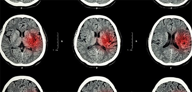 Antidepressiva und NSAR - gefährliche Kombination CT-Aufnahme einer intrakraniellen Hämorrhagie (rot).