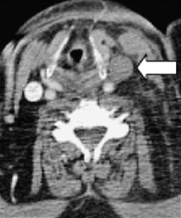 CT-Bild des Halses bei einem 46-Jährigen mit Jugularvenenthrombose. Erkennbar ist der Füllungsdefekt der Vena jugularis interna (Pfeil).