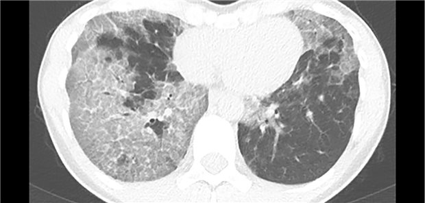 CT-Bild einer jungen Frau mit Alveolarproteinose.