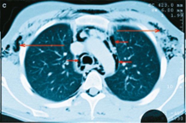 Ecstasy-Konsum führte bei junger Frau zu Pneumomediastinum CT-Bild vom Thorax: Luft in Mediastinum (kurze Pfeile) und Haut (lange Pfeile).