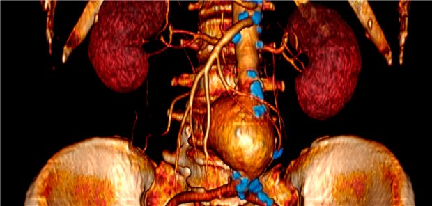 CT-Darstellung eines Bauchaortenaneurysmas