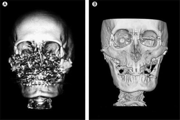 Ärzte geben Gewaltopfer ein neues Gesicht CT-Modell des Gesichts vor (A) und nach (B) der Transplantation. Auch weitgehend zerstörte Gesichtsknochen wurden erfolgreich ersetzt.