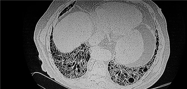CT-Scan einer Lunge.
