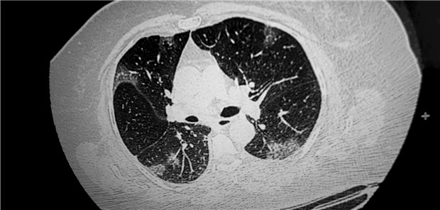 Bei gastrointestinalen Symptomen auch an SARS-CoV-2 denken! CT-Scan der Lunge eines französischen Patienten mit COVID-19.