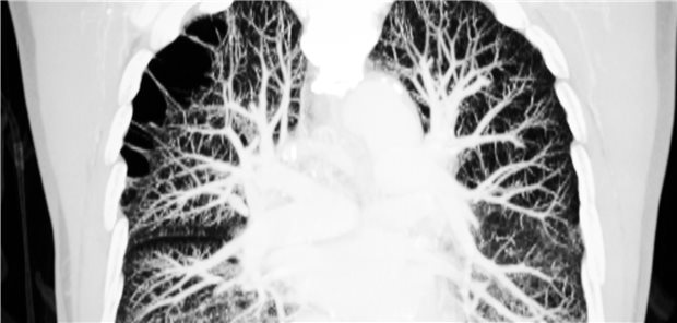 CT der Lunge: Lungenembolien gab es in einer Studie bei mehr COVID-19-Patienten als gedacht.