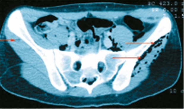 Ecstasy-Konsum führte bei junger Frau zu Pneumomediastinum CT vom Becken: ausgeprägtes Hautemphysem (Pfeile).