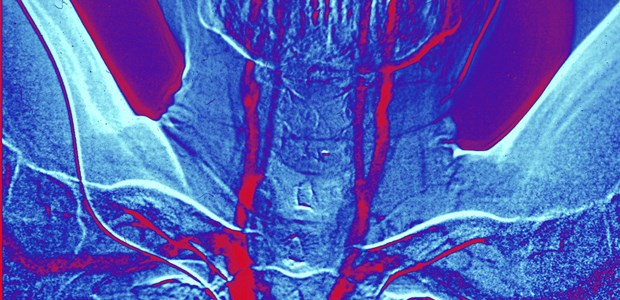 Mehr Schaden als Nutzen? Carotiden: Die Diskussion um Schaden und Nutzen von Stents nach TIA und Insult geht weiter.