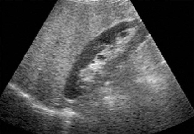 Auch nichtalkoholische Fettleber führt häufig zur Leberzirrhose Charakteristisch für eine Fettleber ist das echodichte Gewebe.
