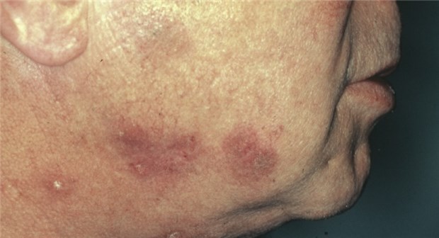 Die vielen Gesichter des L. erythematodes Charakteristisches Merkmal bei Systemischem Lupus erythematodes: Ein Schmetterlingserythem.