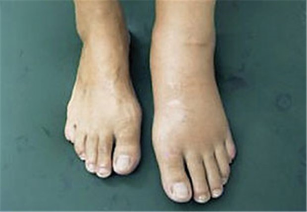 Wenn der Fuß schmerzlos zerstört wird Charcot-Fuß bei einem 45-jährigen Langzeitdiabetiker mit Schwellung und Rötung des linken Fußes.