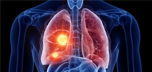 Checkpoint-Inhibitoren haben zur Prognoseverbesserung von Patientinnen und Patienten mit fortgeschrittenem NSCLC beigetragen. Doch Ältere profitieren wohl nicht im gleichen Maß wie Jüngere.