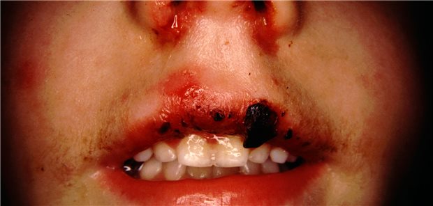 Cheilitis bei Stevens-Johnson-Syndrom.