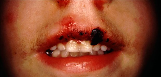 Cheilitis bei Stevens-Johnson-Syndrom