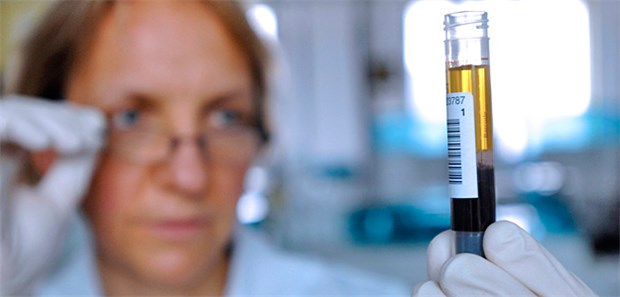 Chemikerin bei der PSA-Wert-Bestimmung: Niedrige PSA-Konzentrationen bei Prostata-Ca mit hohem Gleason-Score sind wohl ein Zeichen für extrem schlecht differenzierte oder anaplastische Karzinome.