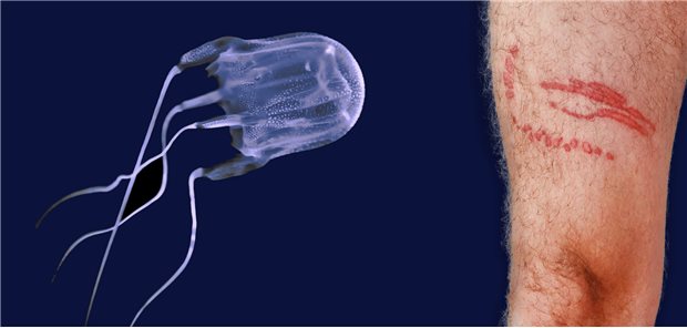 Chironex fleckeri; ihre langen Tentakel verursachen tiefrote, ungeordnete urtikarielle Hautstriemen.