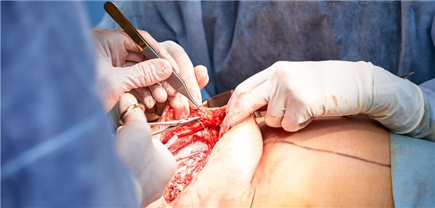 Brustrekonstruktion nach Mammakarzinom: Das sind die Fakten Chirurgie bei Mamma-Ca. Geht es um die Rekonstruktion, bevorzugen viele Frauen Optionen, bei denen Eigengewebe genutzt wird.