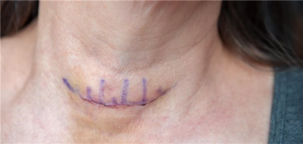Detailaufnahme einer frisch genähte Operationswunde nach einer Schilddrüsenoperation.