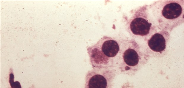 Erster Chlamydien-Impfstoff in klinischen Tests Chlamydia trachomatis aus einem Abstrich der Urethra unterm Mikroskop.