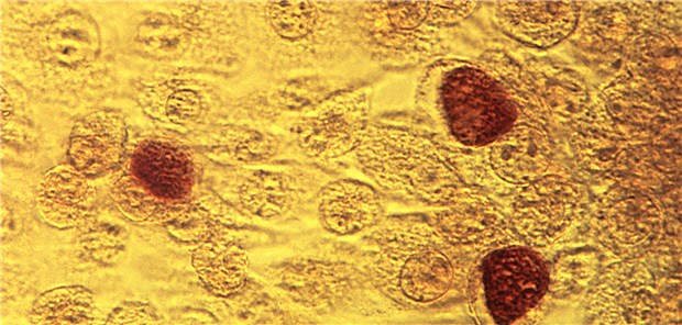 Chlamydien: 20 Prozent der getesteten Patientinnen mit Ovarial-Ca waren seropositiv.