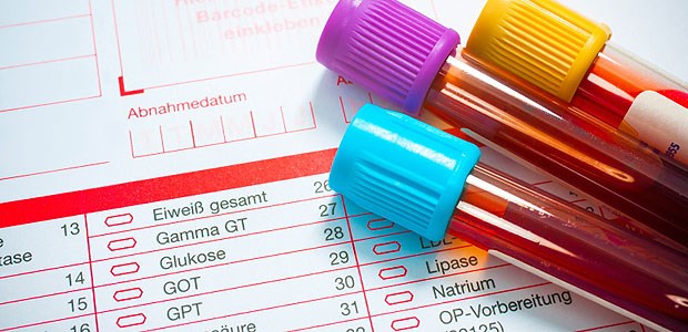 LDL-Zielwerte sind out Cholesterin-Messung: Ist sie noch nötig, wenn Cholesterin-Zielwerte obsolet sind?