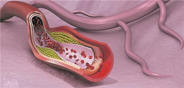 Cholesterin-Plaque