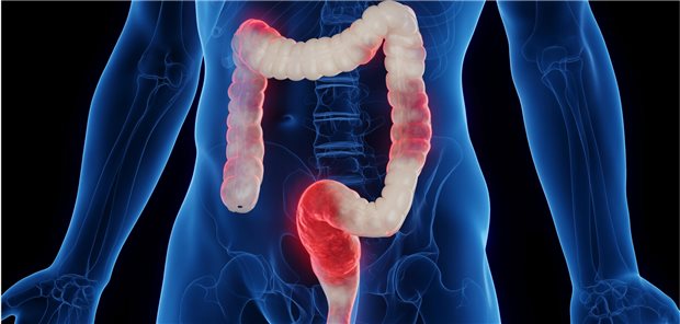 Chronisch entzündliche Darmerkrankung: Frauen in Europa und den USA sind etwa doppelt so häufig von Morbus Crohn betroffen sind wie Männer, berichten zwei Internistinnen. (Symbolbild)