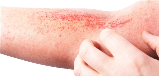 Chronisch entzündliche Hauterkrankung: Obwohl viele Entzündungsfaktoren eine Rolle spielen, birgt die inflammatorische Belastung wohl kein Hintergrundrisiko für venöse Thromboembolien. So das Ergebnis einer US-amerikanischen Untersuchung.