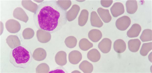 Chronisch lymphatische Leukämie (CLL): eine noch relativ neue Therapieoption sind Brutontyrosinkinase-Inhibitoren.