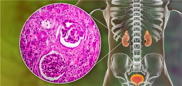 Chronische Glomerulonephritis: Patienten mit HIV haben ein erhöhtes Risiko für Nierenerkrankungen. Da der Anteil älterer HIV-Patienten steigt, wird auch die Aufmerksamkeit für Komorbiditäten immer wichtiger.