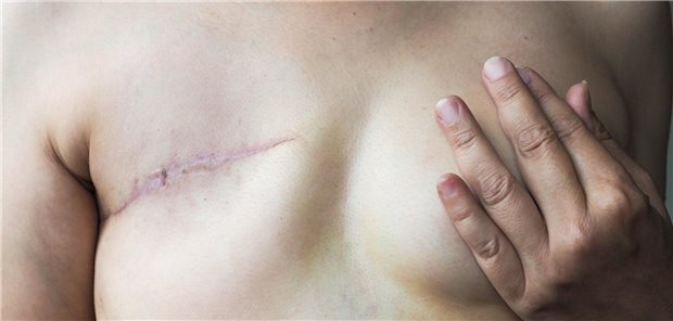 Frau nach Mastektomie 