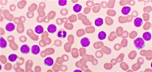 Chronische lymphatische Leukämie: Bei Betroffen, die eine Ibrutinib-Therapie bekommen, sollte auf Anzeichen einer verschlechterten Herzfunktion geachtet werden.