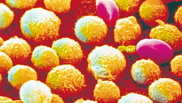 Vor allem bei Älteren: Nutzen und Risiken der Therapie abwägen! Chronische lymphatische Leukämie (CLL): Sie gilt als "Altersleukämie".