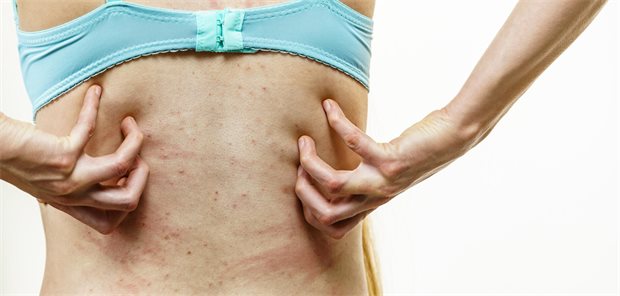 Eine Frau kratzt sich mit beiden Händen am Rücken, rote Streifen sind auf der Haut sichtbar.