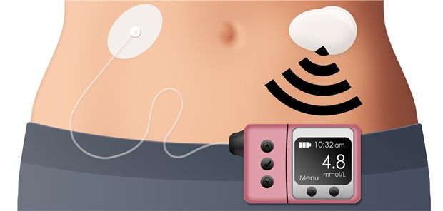 Closed-Loop: Die Pumpe passt die Insulinfreisetzung an die Glukosewerte an.