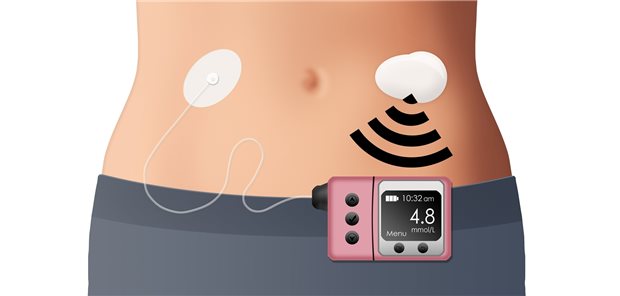 Closed Loop aus Glukose-Sensor und Insulinpumpe. Sophia Winters / stock.adobe.com