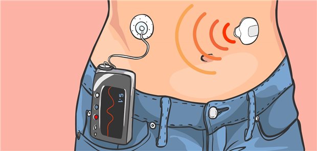 Closed loop: Der Sensor überträgt die aktuellen Glukosewerte an die Pumpe, die wiederum die Insulinabgabe an die Werte anpasst.