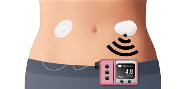 Closed loop mit kontinuierlicher Glukosmessung und Insulinpumpe: Weitere Hormone in der Pumpe könnten die Therapie verfeinern.