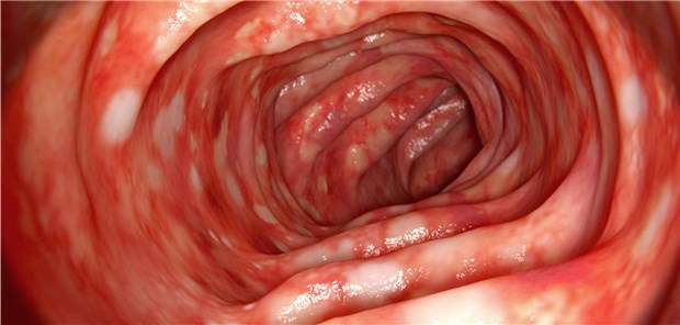 Colitis ulcerosa: Neue pathophysiologische Erkenntnisse liefern auch neue Ansätze zur Behandlung von CED-Patienten.
