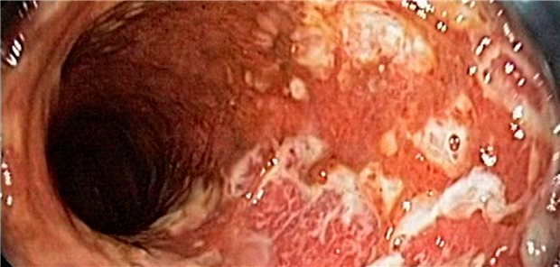 Colitis ulcerosa: Sicht durch das Endoskop auf schwere Inflammationen undUlzerationen im Sigmoid.